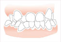 牙齿不齐