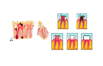 根尖周炎是什么？