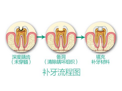 龋齿补牙什么方法好