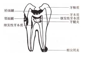 顽固根尖周炎的处理方法