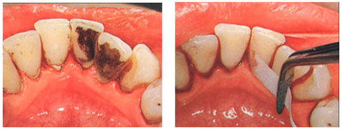 龈下洁治：一种“特殊洗牙”