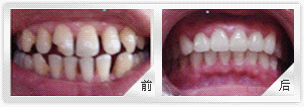 牙齿稀疏是什么原因