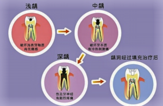 预防龋齿做窝沟封闭多少钱