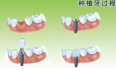 种植牙让你告别缺牙遗憾