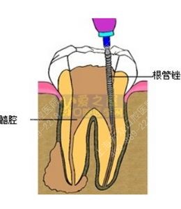 牙根尖周炎根管治疗