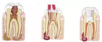 引发根尖周炎原因是什么