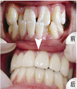 青少年牙列拥挤应该怎么办