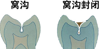 预防孩子蛀牙的防护服