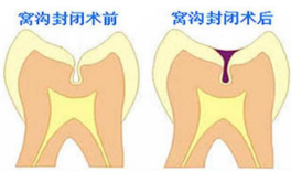 窝沟封闭的具体步骤