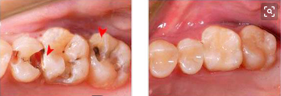 蛀牙怎么办