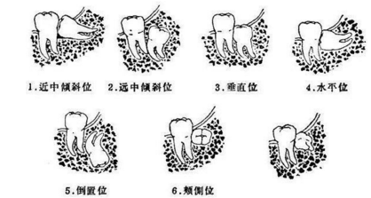 去医院拔智齿多少钱