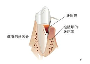 关于牙周炎你必须了解的护理知识