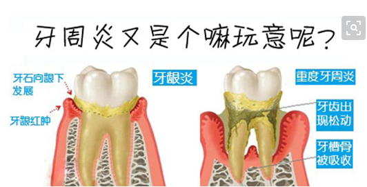 牙周炎不治疗会有什么后果