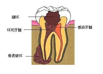 牙髓炎不能自愈须及时治疗