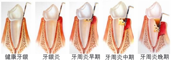  牙周病的4个常见征兆