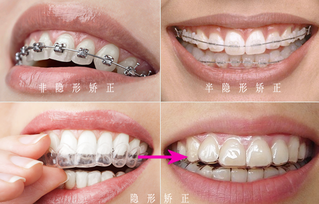 牙齿矫正会不会很痛