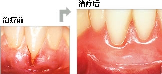 牙周炎治疗过程