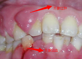 牙龈萎缩怎么回事