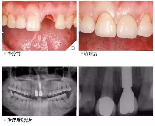 什么事牙种植