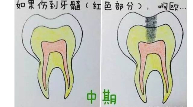 牙齿烂了个洞而且发臭