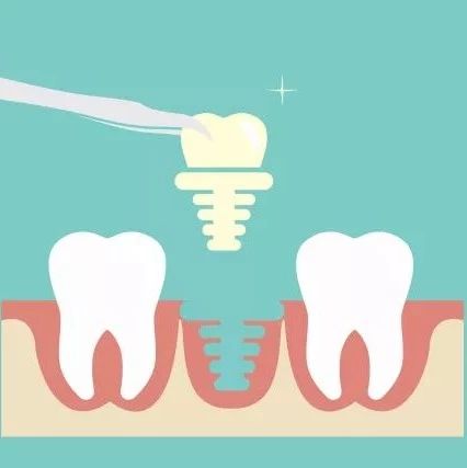 种植牙有几种